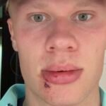 Erling Haaland injured by bus door