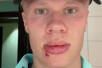 Erling Haaland injured by bus door