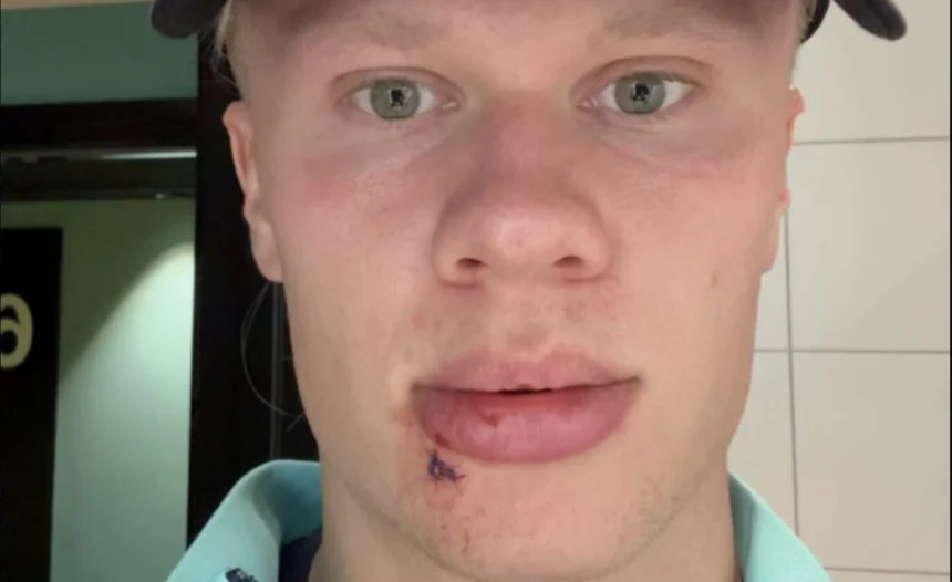Erling Haaland injured by bus door